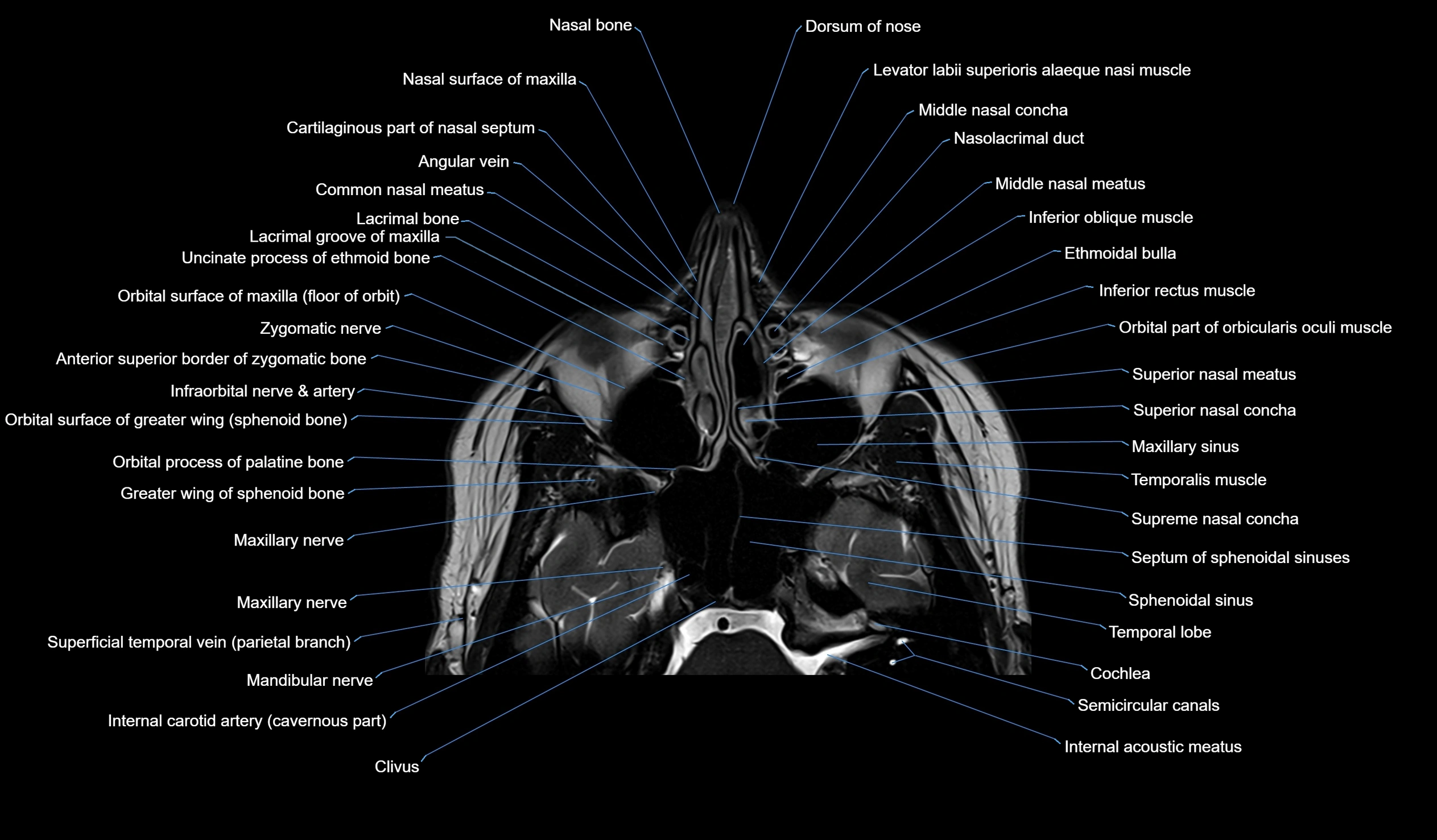 MRI face & paranasal sinuses(PNS) labelled  axial  cross sectional anatomy 3T radiology  image -00016.webp